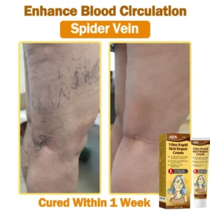 HZA𝟕-𝐃𝐚𝐲 𝐑𝐚𝐩𝐢𝐝 𝐒𝐤𝐢𝐧 𝐑𝐞𝐩𝐚𝐢𝐫 𝐂𝐫𝐞𝐚𝐦 𝐔𝐊 𝐃𝐞𝐫𝐦𝐚𝐭𝐨𝐥𝐨𝐠𝐢𝐬𝐭 𝐀𝐩𝐩𝐫𝐨𝐯𝐞𝐝 (💎💎𝐁𝐀𝐃 𝐑𝐄𝐂𝐎𝐌𝐌𝐄𝐍𝐃𝐄𝐃)