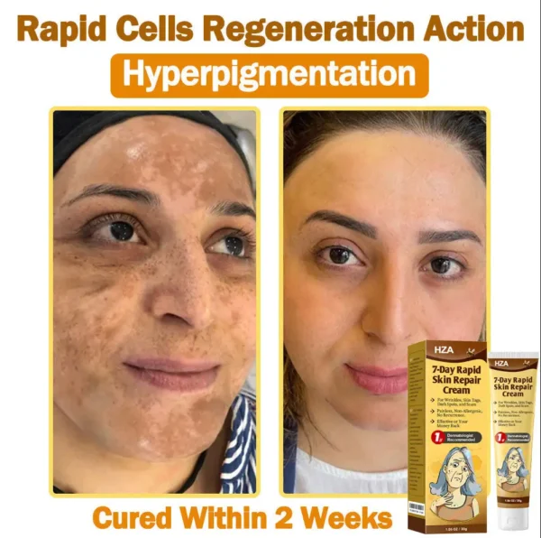HZA𝟕-𝐃𝐚𝐲 𝐑𝐚𝐩𝐢𝐝 𝐒𝐤𝐢𝐧 𝐑𝐞𝐩𝐚𝐢𝐫 𝐂𝐫𝐞𝐚𝐦 𝐔𝐊 𝐃𝐞𝐫𝐦𝐚𝐭𝐨𝐥𝐨𝐠𝐢𝐬𝐭 𝐀𝐩𝐩𝐫𝐨𝐯𝐞𝐝 (💎💎𝐁𝐀𝐃 𝐑𝐄𝐂𝐎𝐌𝐌𝐄𝐍𝐃𝐄𝐃)
