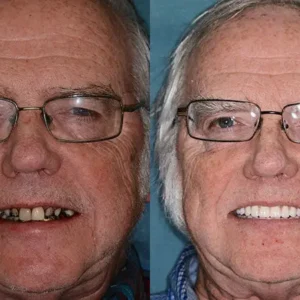 HZA™ --Made in Germany Advanced Customized Full Denture Set