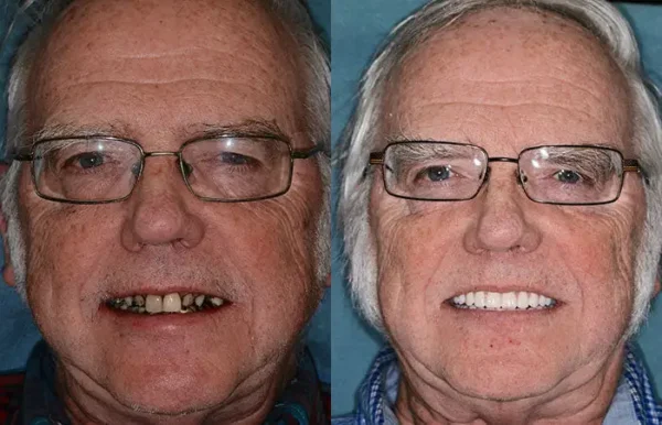HZA™ --Made in Germany Advanced Customized Full Denture Set