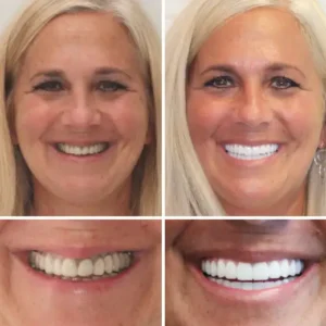 HZA™ --Made in Germany Advanced Customized Full Denture Set