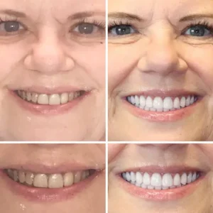 HZA™ --Made in Germany Advanced Customized Full Denture Set