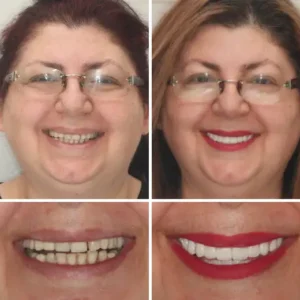 HZA™ --Made in Germany Advanced Customized Full Denture Set