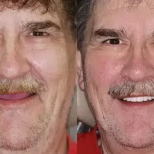 SmileFitPro HZA™ Premium Denture