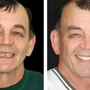 SmileFitPro HZA™ Premium Denture