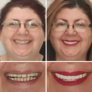 SmileFitPro HZA™ Premium Denture