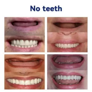 SmileFitPro™ New Generation Flexible Full Denture Solution