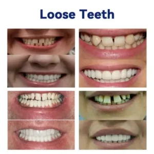 SmileFitPro™ New Generation Flexible Full Denture Solution