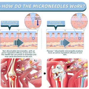 Thonesr® Nano-microneedle joint patch
