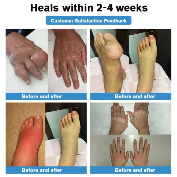 Thonesr® Nano-microneedle joint patch