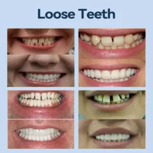 SmileFitPro® – MedicalFit Adaptive Dentures – Suitable for all mouth shapes, perfect fit