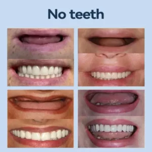 SmileFitPro® – MedicalFit Adaptive Dentures – Suitable for all mouth shapes, perfect fit