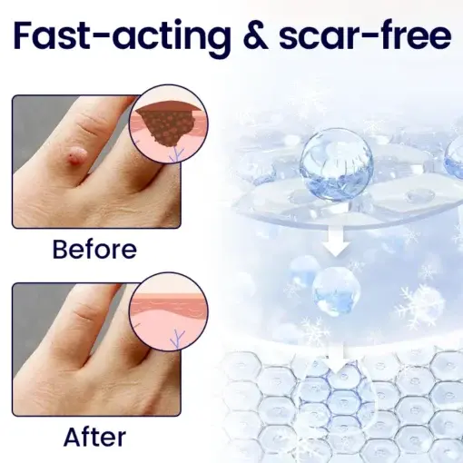 Cvreoz® WartFreez Cryo Wart Removal Spray