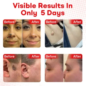 Cvreoz®MicroNeedle BotanicSkin Tag Removal Patch